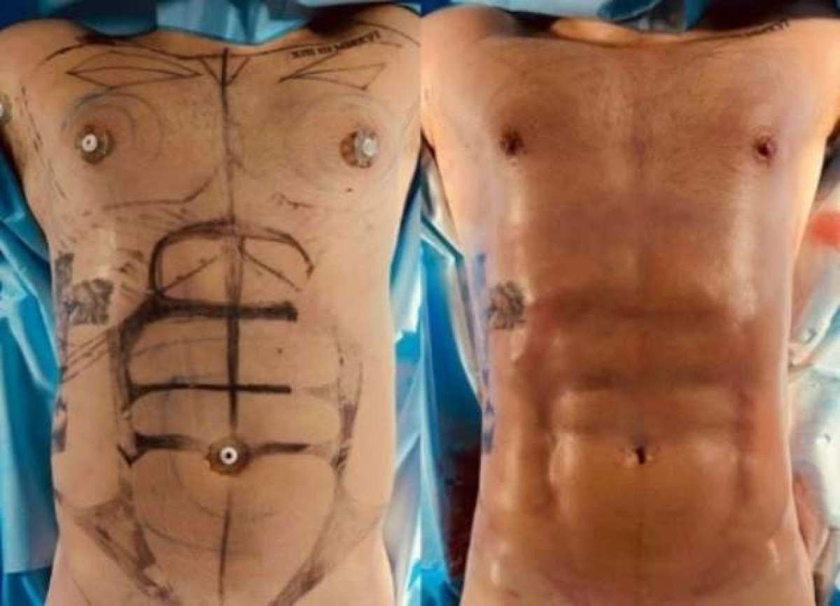 Ex-BBB21 Caio Afiune faz lipo LAD; confira o antes e depois