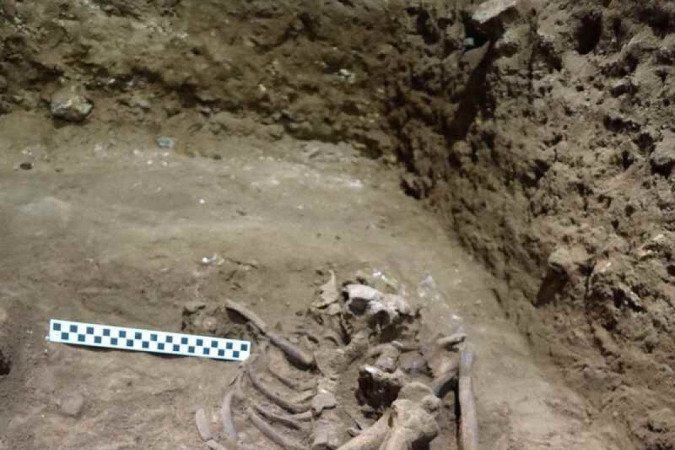Esqueleto foi encontrado em 2020: cirurgia demandou 