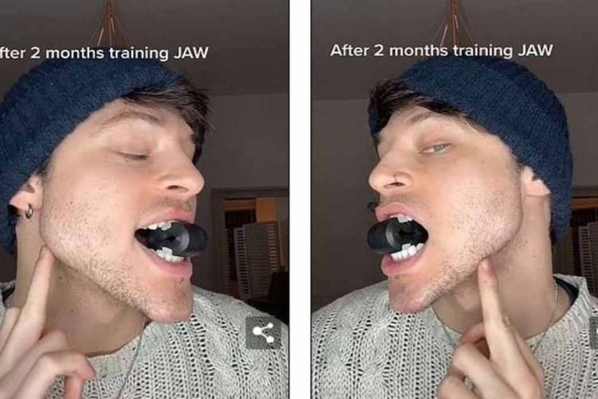 Mewing Antes E Depois | Golden Jaw Treino Mandibula Funciona