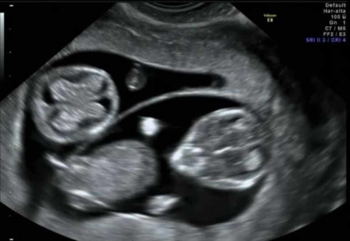 Roseni da Silva, 38 anos, está grávida de 33 semanas e disse que foi assustador descobrir a gestação de quatro bebês 