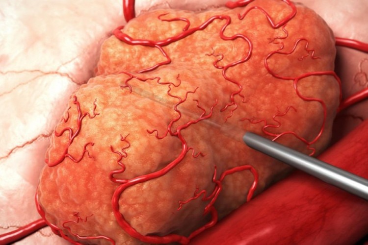 Nova radioterapia é promissora contra tumores preservando tecido saudável; entenda