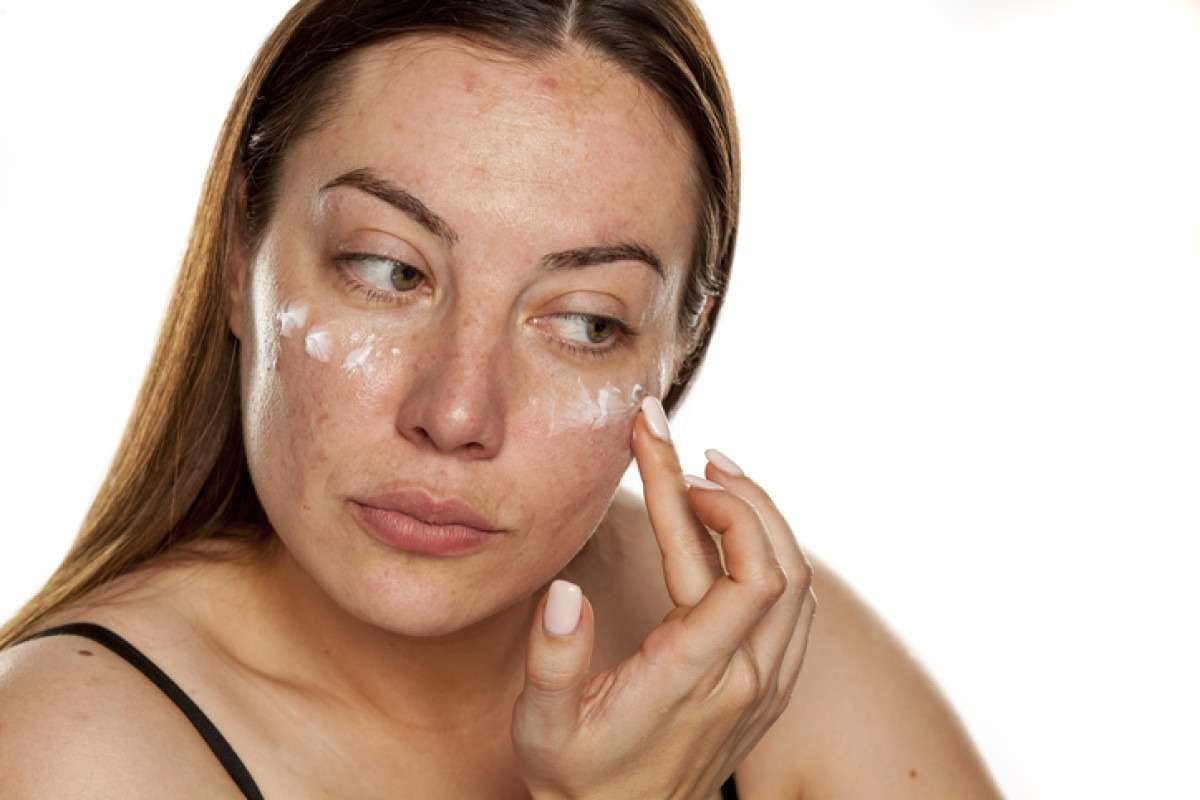 Melasma na gestação? Conheça 4 produtos para clarear as manchas