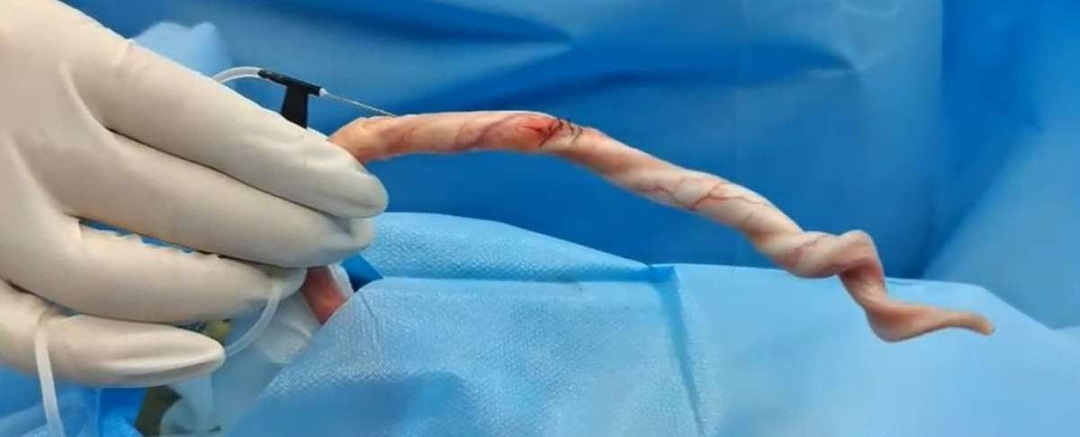 Tecido artificial restaura lesões penianas e recupera função erétil