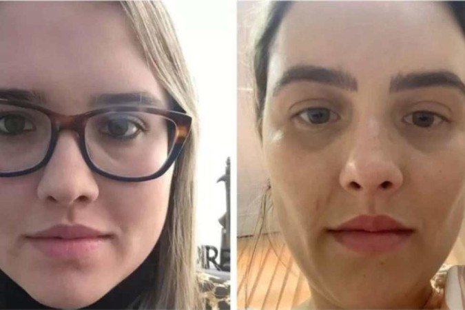 Fabiula Bianchi antes e depois da bichectomia: decepção com o procedimento