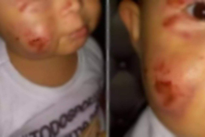 Criança teve ferimentos no rosto, no braço e nas costas durante permanência em uma creche - (crédito: Arquivo pessoal) Criança teve ferimentos no rosto, no braço e nas costas durante permanência em uma creche - (crédito: Arquivo pessoal)