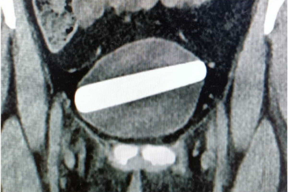 Mulher passa por cirurgia após ficar com brinquedo sexual preso na bexiga