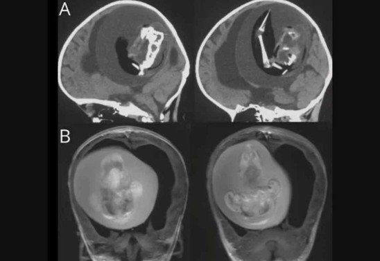 Reprodução/Revista Neurology