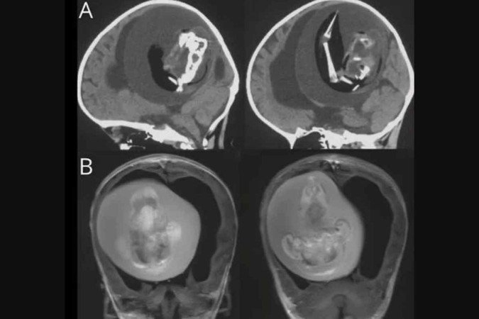 (crédito: Reprodução/Revista Neurology) (crédito: Reprodução/Revista Neurology)