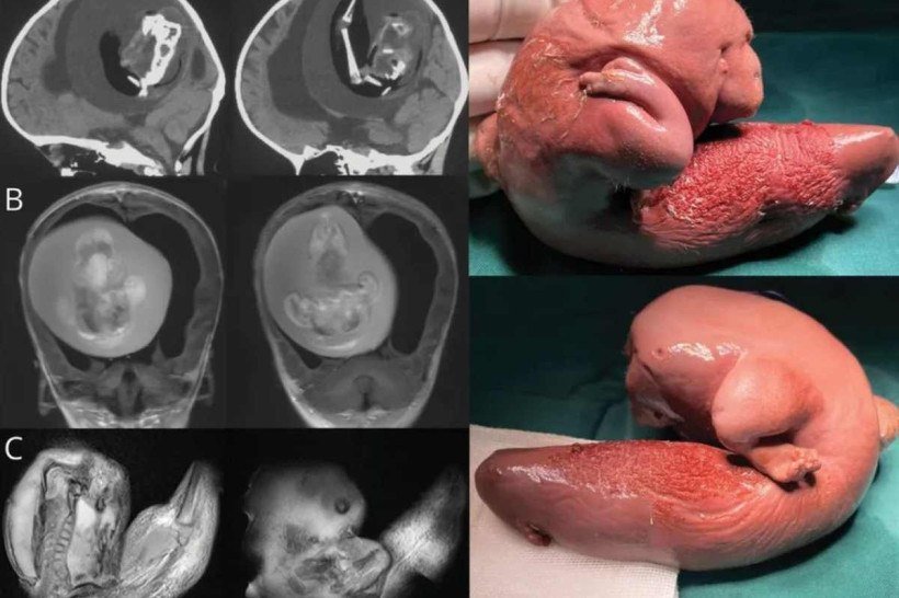 Imagens tomografia da menina chinesa 