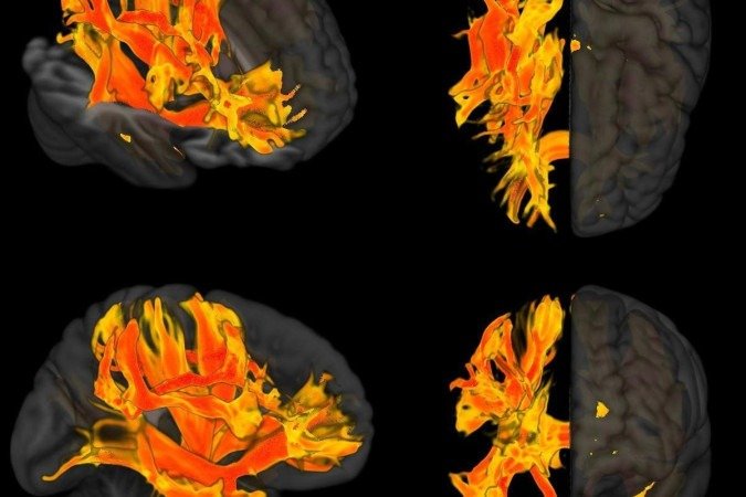 Em vermelho e amarelo, os impactos da alta pressão arterial sistólica na substância branca 