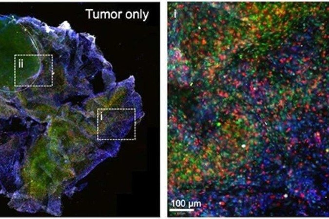 À ESQUERDA: Um tumoróide impresso em 3D após 48 horas de incubação com células imunológicas. DIREITA: A seção ampliada (i) mostra as células imunológicas (em verde e vermelho) se infiltrando nos tumoróides impressos em 3D.