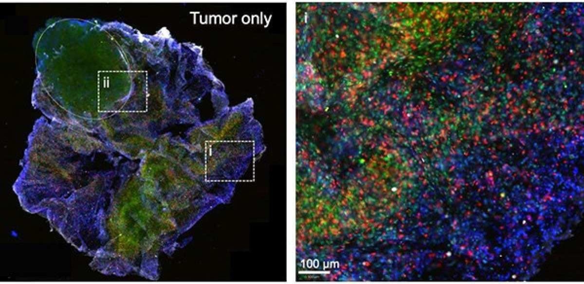 À ESQUERDA: Um tumoróide impresso em 3D após 48 horas de incubação com células imunológicas. DIREITA: A seção ampliada (i) mostra as células imunológicas (em verde e vermelho) se infiltrando nos tumoróides impressos em 3D.