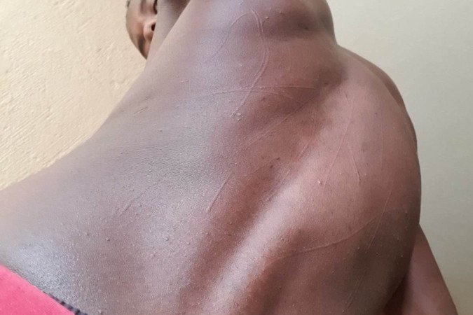 Ronald Agaba, 25 anos, mostra hematomas nas costas: ataque com bastões e fio em mercado de alimentos