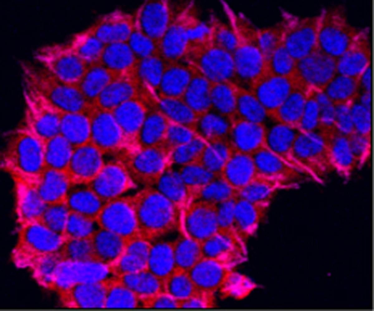 Vacina de mRNA experimental combate câncer de pâncreas