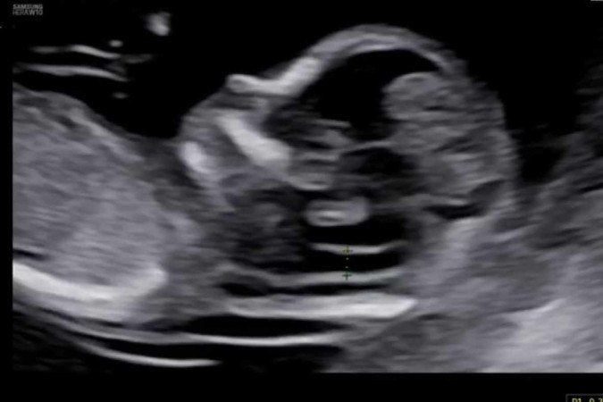 Ultrassom de bebê de 13 semanas