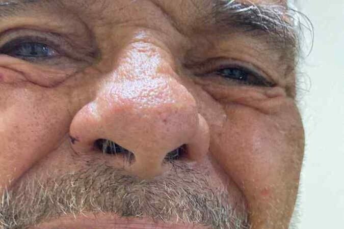 Dente quebrado devido as agressões - (crédito: Material cedido ao Correio ) Dente quebrado devido as agressões - (crédito: Material cedido ao Correio )