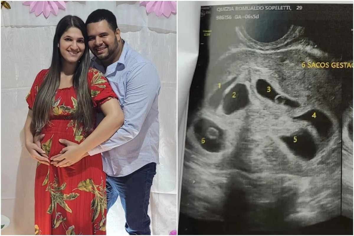 Casal descobre gestação de sêxtuplos em ultrassom de um bebê