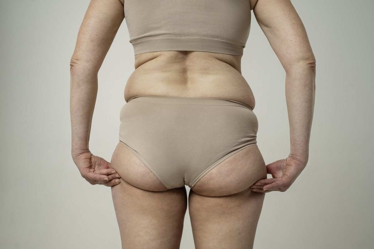 Lipedema: doença atinge quase que exclusivamente mulheres