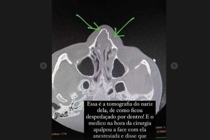 A nutricionista teve fratura no nariz após a agressão do homem - (crédito: Reprodução/Instagram/@teca_bonatto) A nutricionista teve fratura no nariz após a agressão do homem - (crédito: Reprodução/Instagram/@teca_bonatto)