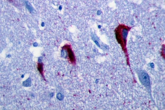 Emaranhados de fibras formados no cérebro de pessoas com Alzheimer: caminho de intervenção
- (crédito: Wikemedia Commons/Divulgação ) Emaranhados de fibras formados no cérebro de pessoas com Alzheimer: caminho de intervenção
- (crédito: Wikemedia Commons/Divulgação )
