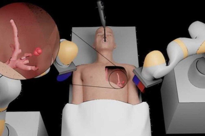 Experimentos avaliaram 
desempenho em cirurgias para tumores nos pulmões e no cérebro: melhora média na profundidade de 
navegação de 37%