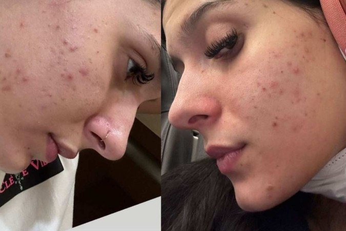 A cantora falou sobre problemas com acnes. - (crédito: Reprodução / Instagram / Ana Castela ) A cantora falou sobre problemas com acnes. - (crédito: Reprodução / Instagram / Ana Castela )