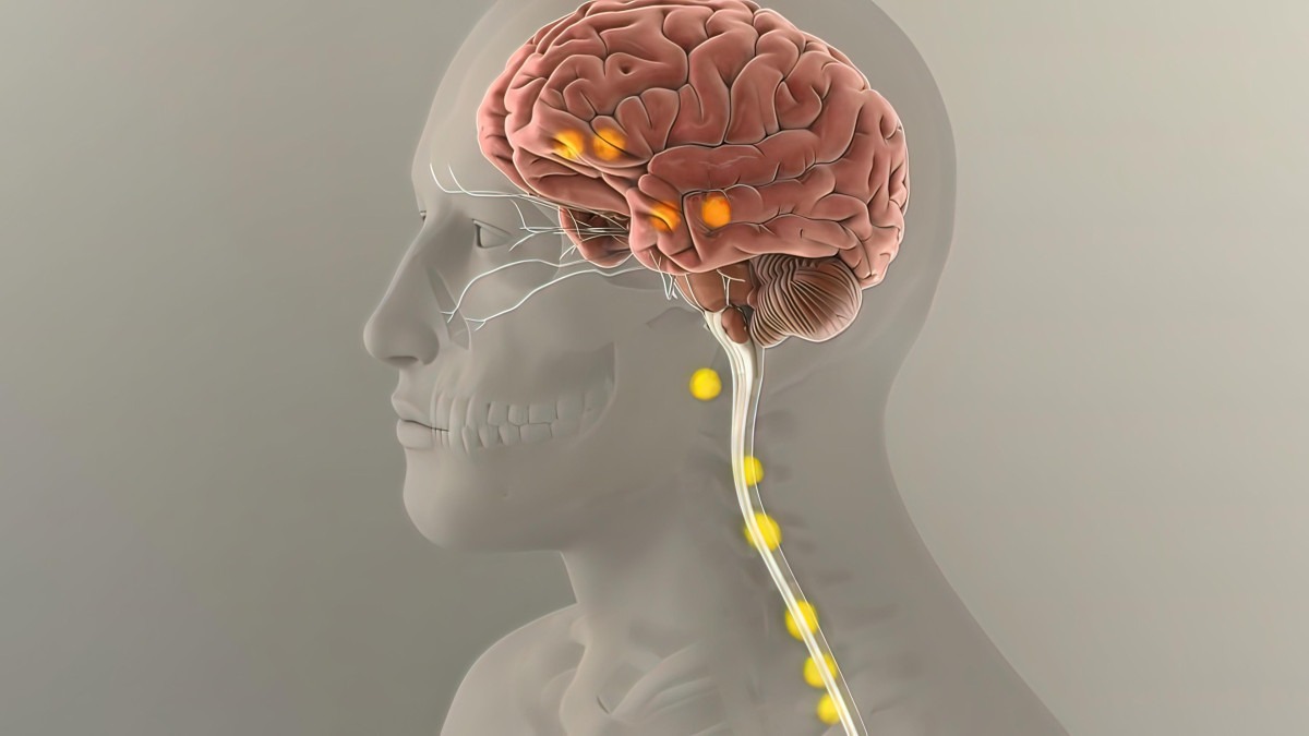 Como funciona implante para tratar depressão resistente que será aplicado pela 1ª vez no Brasil