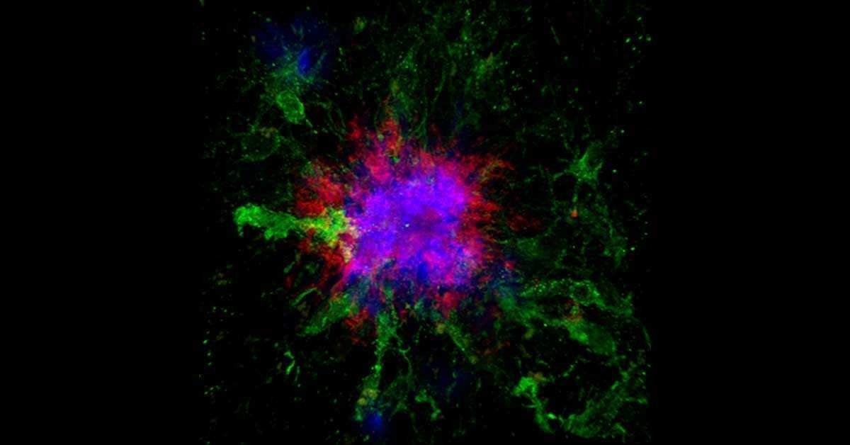 Esta imagem de microscopia confocal mostra placas amiloides (azuis e vermelhas) no cérebro de um camundongo. O acúmulo de placas amiloides é a marca bioquímica mais bem documentada da doença de Alzheimer.