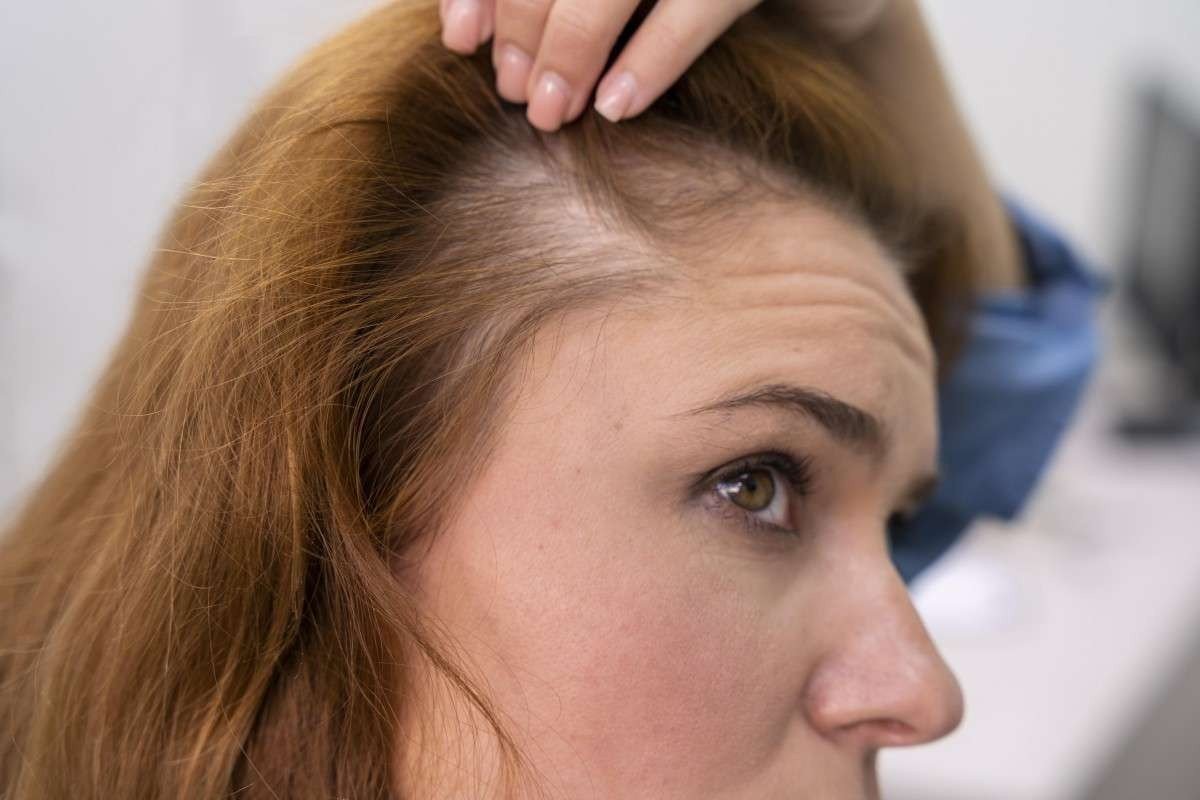 Alopecia: veja famosas com o diagnóstico da doença
