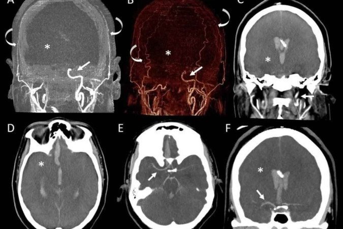 Tomografia computadorizada da fase arterial (CTA) do crânio da mulher - (crédito: Moguillansky et al) Tomografia computadorizada da fase arterial (CTA) do crânio da mulher - (crédito: Moguillansky et al)