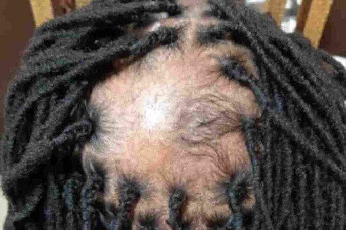 Pessoa com alopecia recebe dreads no Salão Rainha de Sabá