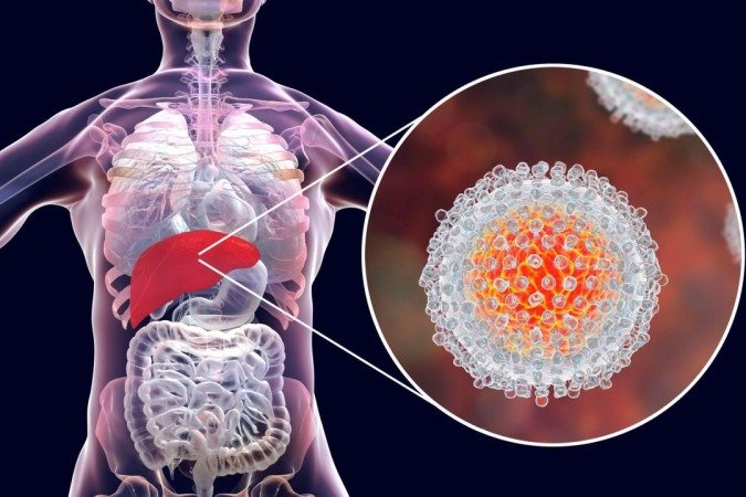 Infecção por hepatite C: Ilustração mostra o fígado e uma visão aproximada dos vírus da hepatite C - (crédito: Getty Images) Infecção por hepatite C: Ilustração mostra o fígado e uma visão aproximada dos vírus da hepatite C - (crédito: Getty Images)