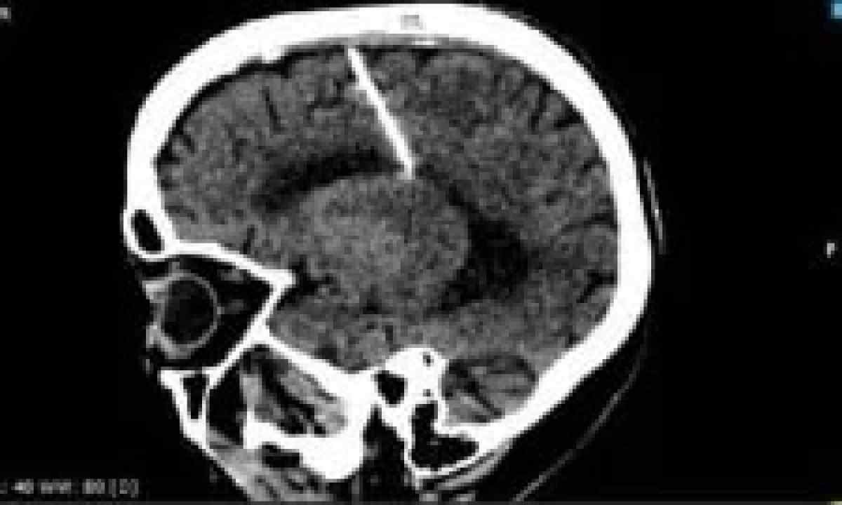 Idosa faz tomografia e descobre agulha de 3cm enfiada no cérebro