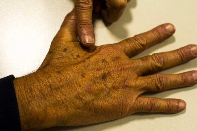 A região do Brasil mais afetada pelos tumores dermatológicos é o Sul do país. - (crédito: Marcello Casal Jr/Agência Brasil) A região do Brasil mais afetada pelos tumores dermatológicos é o Sul do país. - (crédito: Marcello Casal Jr/Agência Brasil)