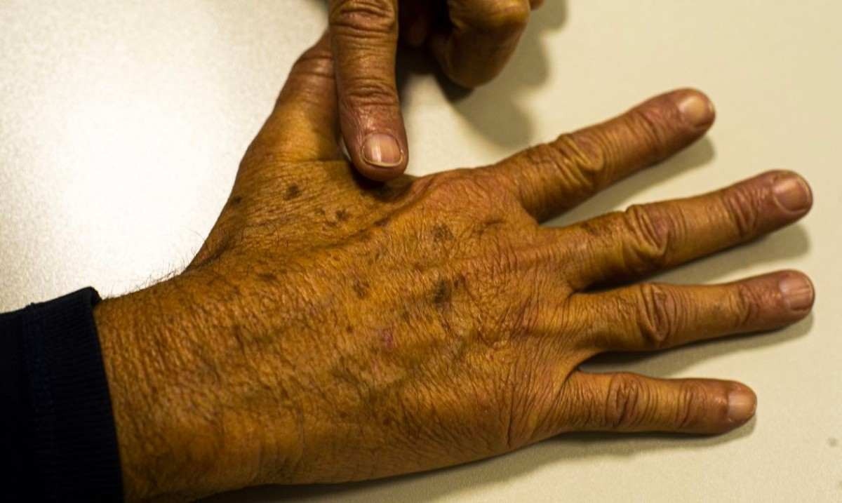 Risco de câncer de pele aumenta com exposição aos raios ultravioletas