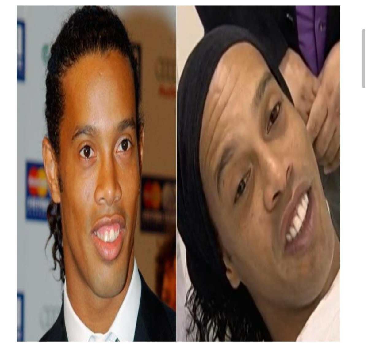 O antes e depois do sorriso de Ronaldinho Gaúcho 