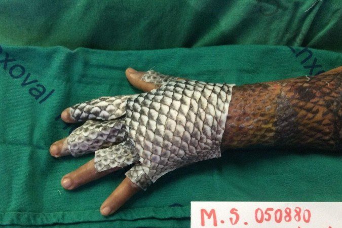 Pele de tilápia aplicada em paciente com queimaduras - (crédito: Arquivo pessoal) Pele de tilápia aplicada em paciente com queimaduras - (crédito: Arquivo pessoal)