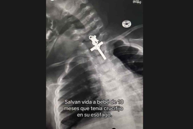 Segundo o médico responsável pelo caso, a retirada do objeto ocorreu no sábado (11/11). O procedimento foi considerado delicado -  (crédito: Reprodução/Instagram/@essaludperu (15/11/2023))