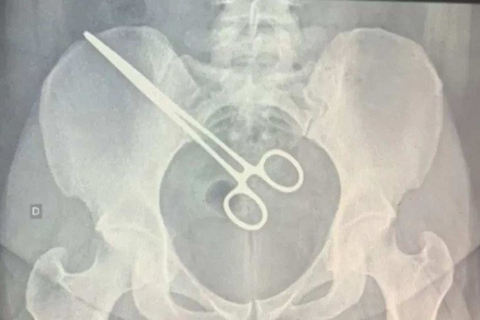 A mulher realizou uma cirurgia na Santa Casa de Araçatuba para a retirada de um feto gerado em uma das trompas em setembro deste ano - (crédito: Reprodução/TV Tem/Globo) A mulher realizou uma cirurgia na Santa Casa de Araçatuba para a retirada de um feto gerado em uma das trompas em setembro deste ano - (crédito: Reprodução/TV Tem/Globo)