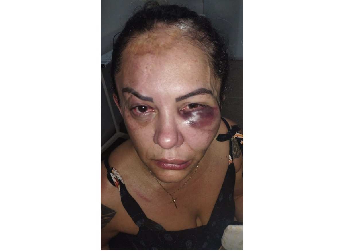 Tentativa de feminicídio: mulher fica com rosto inchado após agressões