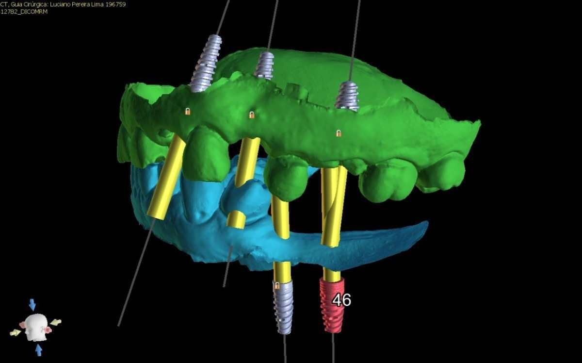 As imagens de alta precisão em 3D localizaram os pontos exatos que iriam os pinos para os implantes