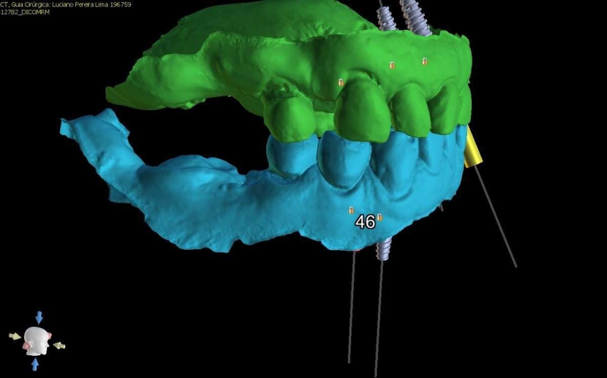 As imagens de alta precisão em 3D localizaram os pontos exatos que iriam os pinos para os implantes