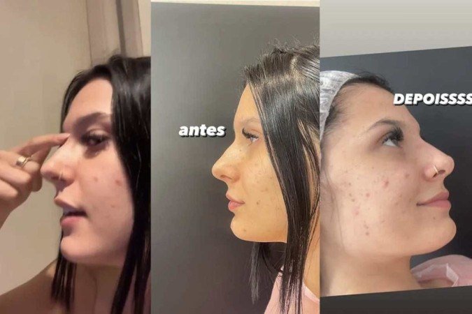 O antes e depois da rinomodelação da cantora Ana Castela - (crédito: Reprodução Instagram) O antes e depois da rinomodelação da cantora Ana Castela - (crédito: Reprodução Instagram)