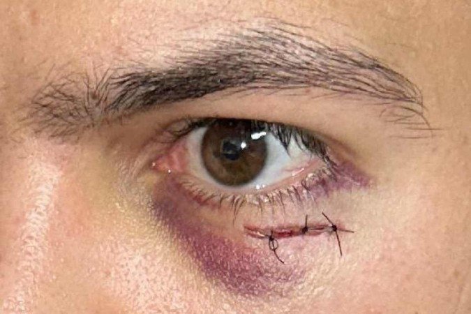 Médico agredido em UPA de Águas Lindas levou três pontos abaixo do olho - (crédito: Material cedido ao Correio) Médico agredido em UPA de Águas Lindas levou três pontos abaixo do olho - (crédito: Material cedido ao Correio)