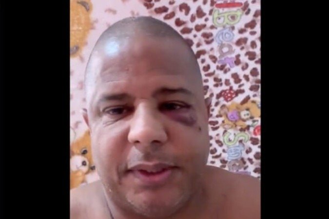 Marcelinho Carioca apareceu com hematoma no rosto -  (crédito: Foto: Reprodução / Redes Sociais)