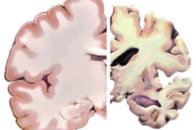 Cérebro saudável (E) e tecidos com lesões relacionadas à demência:
estilo de vida influencia na deterioração dos tecidos
- (crédito: National Institutes of Health/Divulgação ) Cérebro saudável (E) e tecidos com lesões relacionadas à demência:
estilo de vida influencia na deterioração dos tecidos
- (crédito: National Institutes of Health/Divulgação )