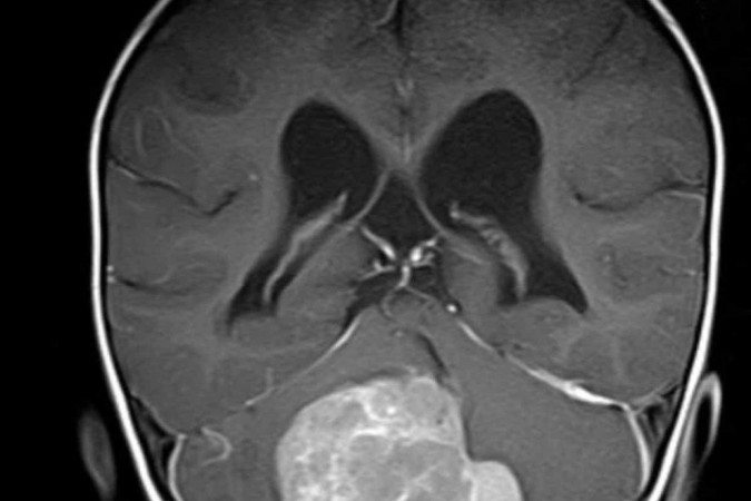 No meduloblastoma com extensa nodularidade (MBEN), pequenas câmaras de tecido são delimitadas dentro do tumor  -  (crédito: © Ghasemi / KiTZ)