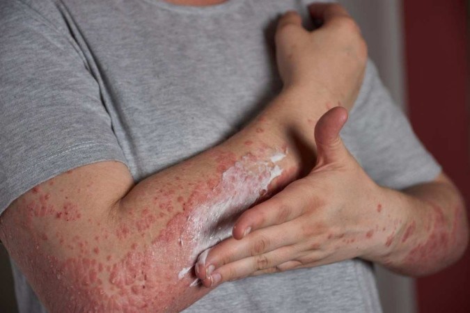  A identificação da alergia só é possível depois da manifestação de um primeiro sintoma  -  (crédito: wirestock/Freepik)