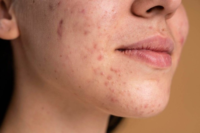 Segundo uma pesquisa conduzida pela Sociedade Brasileira de Dermatologia (SBD), que contou com a participação de 885 dermatologistas, de 25 estados, a acne desponta como a condição mais buscada, representando 771 das 9.629 consultas realizadas durante o estudo -  (crédito: Freepik)