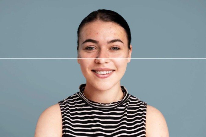 Considerado uma epidemia brasileira, melasma atinge cerca de 35% das mulheres do país
- (crédito: Freepik) Considerado uma epidemia brasileira, melasma atinge cerca de 35% das mulheres do país
- (crédito: Freepik)